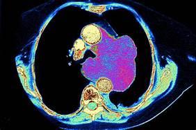 LMS Tumor Assessment